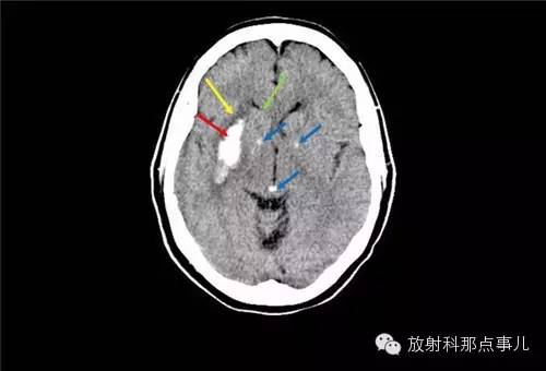 非增强颅脑CT 那些不可错过的细节