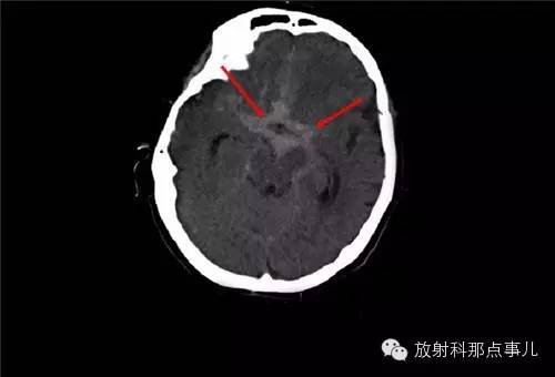 非增强颅脑CT 那些不可错过的细节