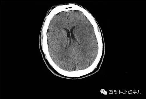 非增强颅脑CT 那些不可错过的细节