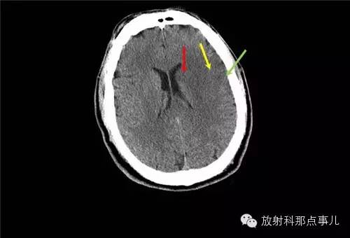 非增强颅脑CT 那些不可错过的细节
