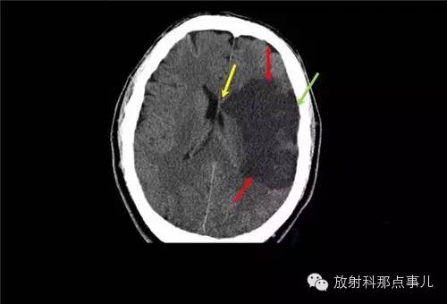 非增强颅脑CT 那些不可错过的细节