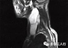 【病例】颈部神经纤维瘤1例CT及MR影像分析 【病例】颈部神经纤维瘤1例CT及MR影像分析