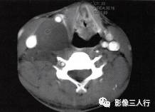 【病例】颈部神经纤维瘤1例CT及MR影像分析 【病例】颈部神经纤维瘤1例CT及MR影像分析