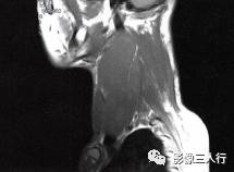【病例】颈部神经纤维瘤1例CT及MR影像分析 【病例】颈部神经纤维瘤1例CT及MR影像分析