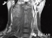 【病例】颈部神经纤维瘤1例CT及MR影像分析 【病例】颈部神经纤维瘤1例CT及MR影像分析