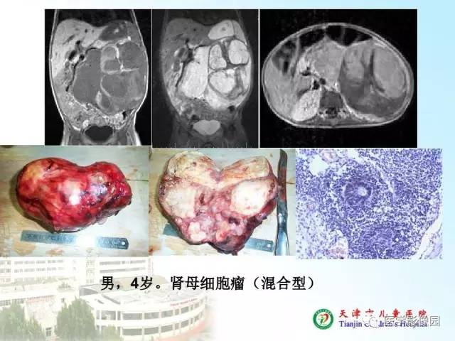 【PPT】小儿腹部肿瘤影像与病理对照