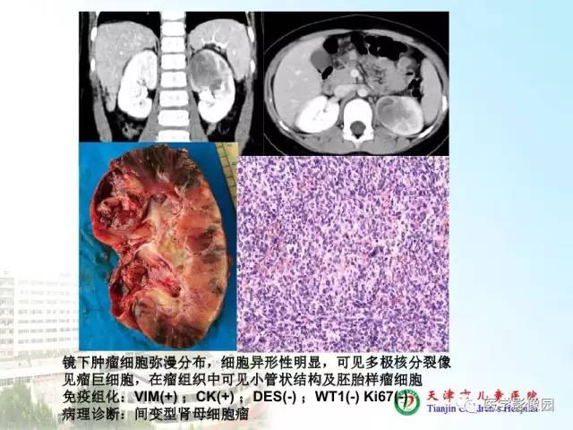 【PPT】小儿腹部肿瘤影像与病理对照