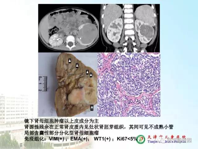 【PPT】小儿腹部肿瘤影像与病理对照