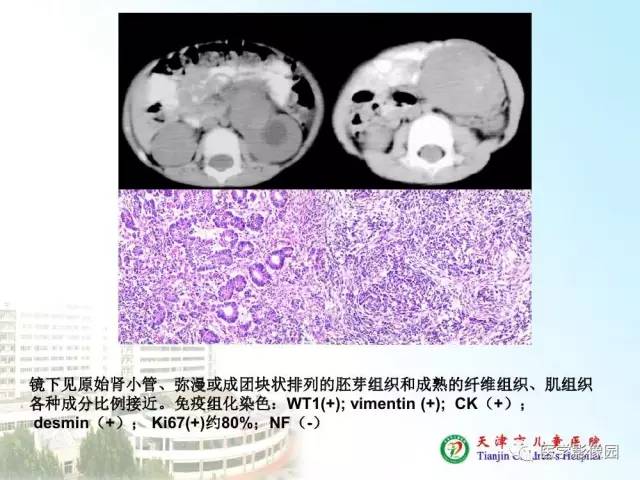 【PPT】小儿腹部肿瘤影像与病理对照