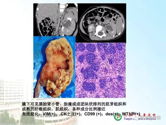 【PPT】小儿腹部肿瘤影像与病理对照