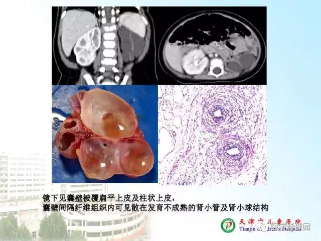 【PPT】小儿腹部肿瘤影像与病理对照