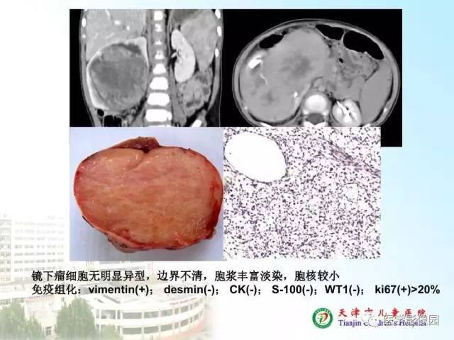 【PPT】小儿腹部肿瘤影像与病理对照
