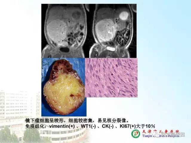 【PPT】小儿腹部肿瘤影像与病理对照