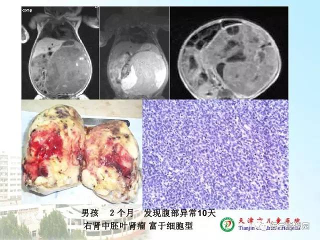 【PPT】小儿腹部肿瘤影像与病理对照