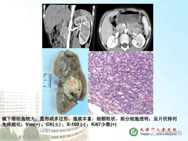 【PPT】小儿腹部肿瘤影像与病理对照