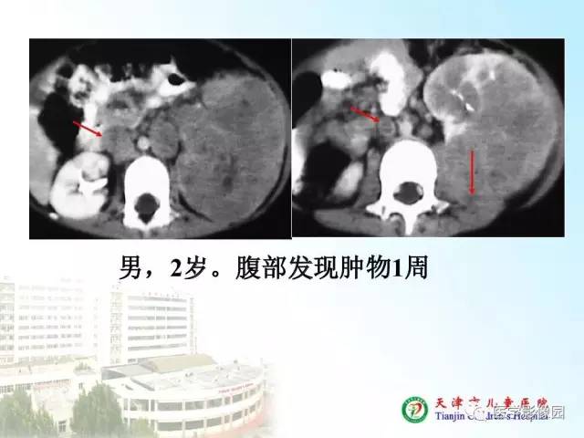 【PPT】小儿腹部肿瘤影像与病理对照