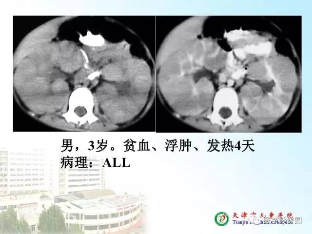 【PPT】小儿腹部肿瘤影像与病理对照