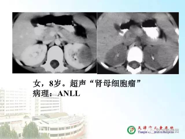 【PPT】小儿腹部肿瘤影像与病理对照