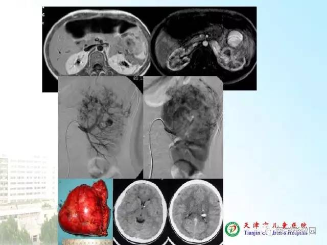 【PPT】小儿腹部肿瘤影像与病理对照