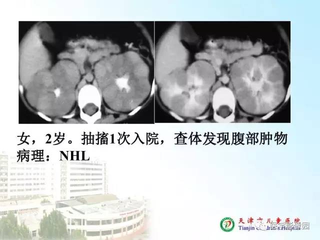 【PPT】小儿腹部肿瘤影像与病理对照