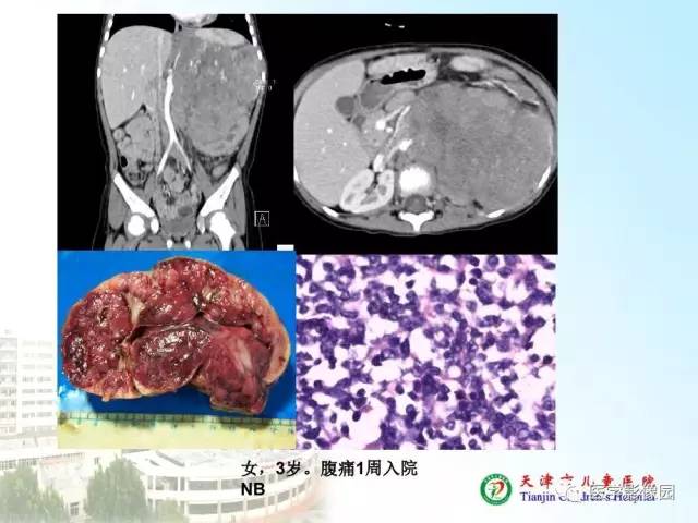 【PPT】小儿腹部肿瘤影像与病理对照