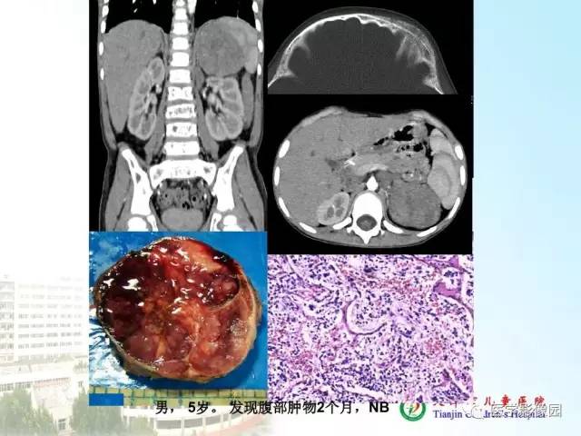 【PPT】小儿腹部肿瘤影像与病理对照