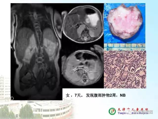 【PPT】小儿腹部肿瘤影像与病理对照