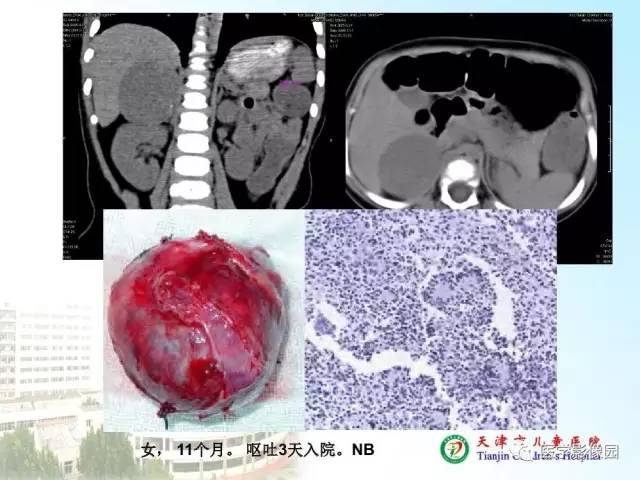 【PPT】小儿腹部肿瘤影像与病理对照