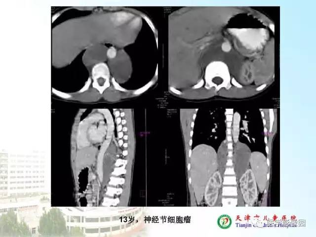 【PPT】小儿腹部肿瘤影像与病理对照