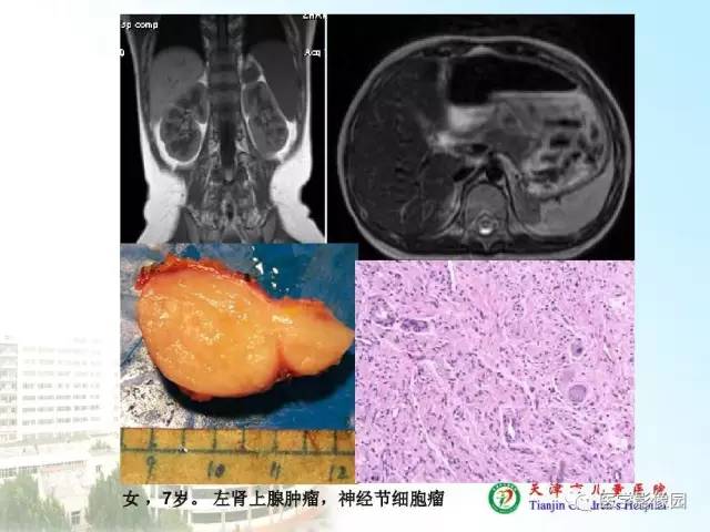 【PPT】小儿腹部肿瘤影像与病理对照