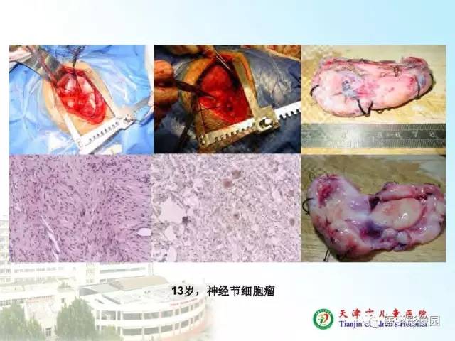 【PPT】小儿腹部肿瘤影像与病理对照
