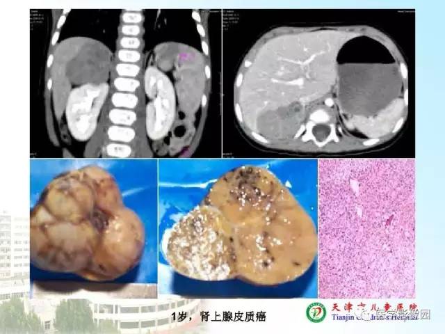 【PPT】小儿腹部肿瘤影像与病理对照