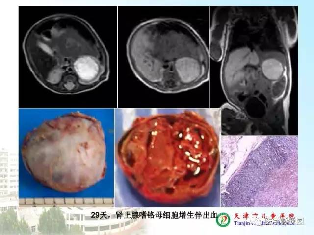 【PPT】小儿腹部肿瘤影像与病理对照