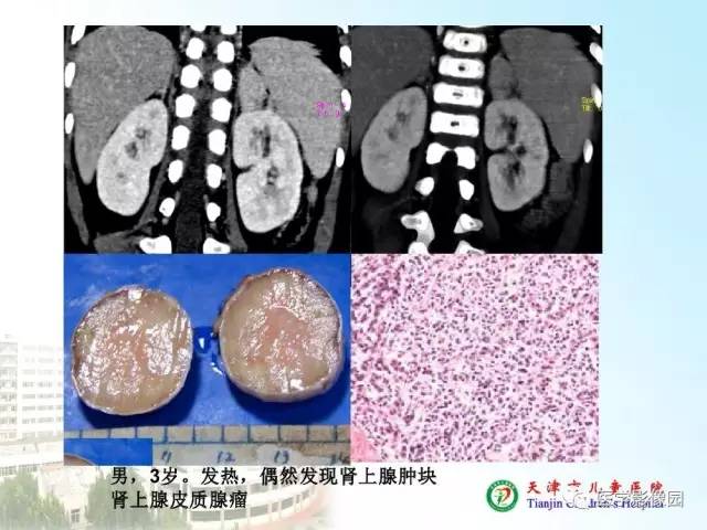 【PPT】小儿腹部肿瘤影像与病理对照