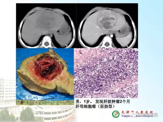 【PPT】小儿腹部肿瘤影像与病理对照
