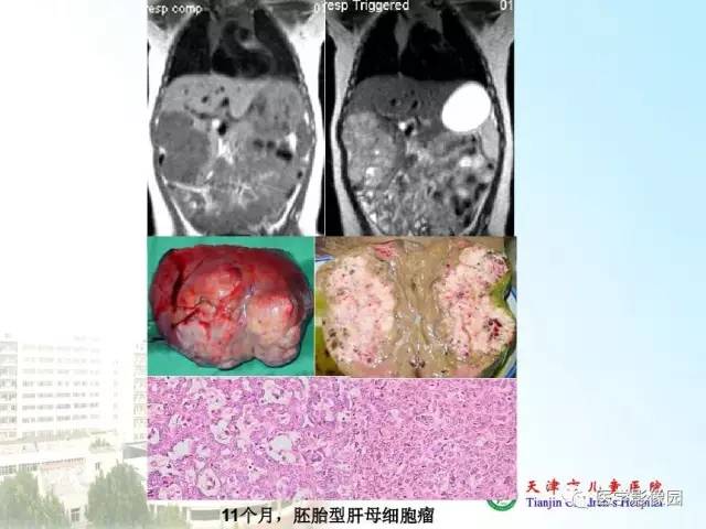 【PPT】小儿腹部肿瘤影像与病理对照