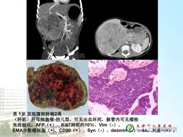 【PPT】小儿腹部肿瘤影像与病理对照