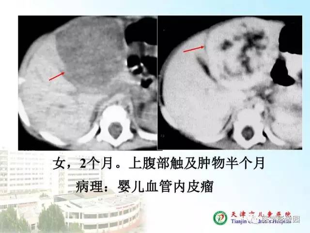 【PPT】小儿腹部肿瘤影像与病理对照