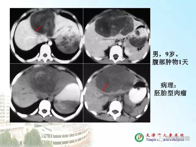 【PPT】小儿腹部肿瘤影像与病理对照