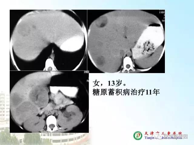 【PPT】小儿腹部肿瘤影像与病理对照