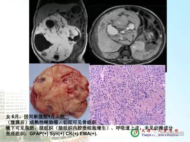 【PPT】小儿腹部肿瘤影像与病理对照