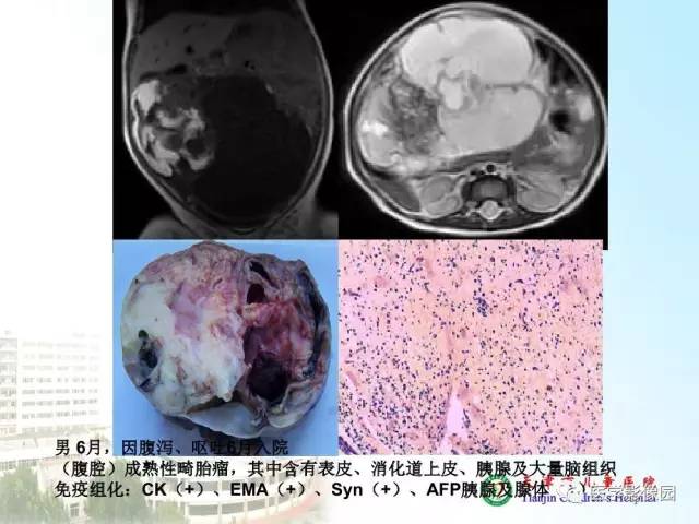 【PPT】小儿腹部肿瘤影像与病理对照