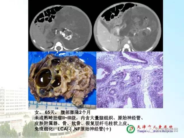 【PPT】小儿腹部肿瘤影像与病理对照