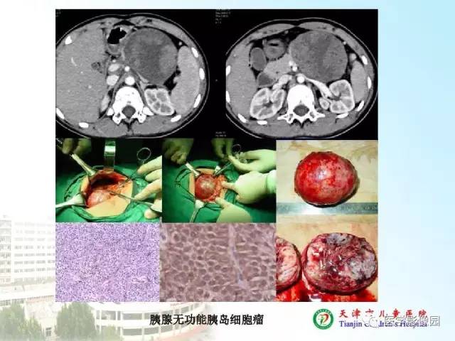 【PPT】小儿腹部肿瘤影像与病理对照