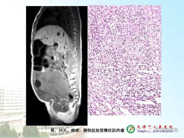 【PPT】小儿腹部肿瘤影像与病理对照