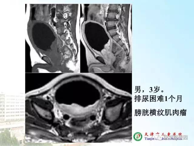 【PPT】小儿腹部肿瘤影像与病理对照