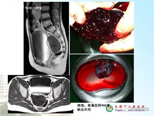 【PPT】小儿腹部肿瘤影像与病理对照