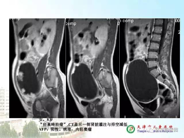 【PPT】小儿腹部肿瘤影像与病理对照
