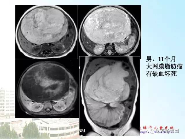 【PPT】小儿腹部肿瘤影像与病理对照