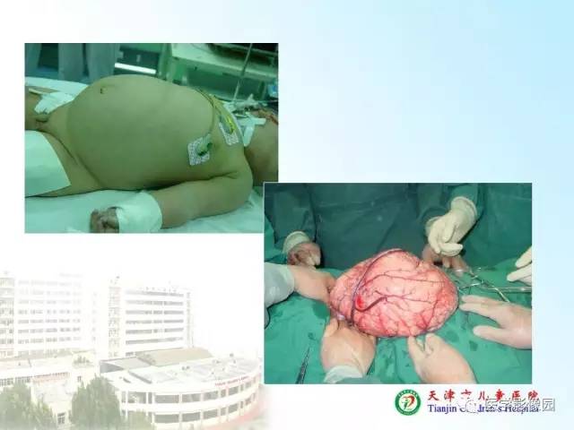 【PPT】小儿腹部肿瘤影像与病理对照
